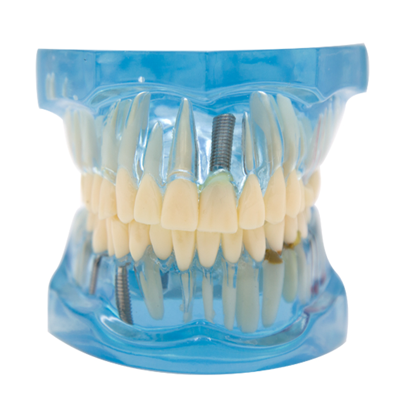 蓝色透明牙模（可拆卸）FM-D003 - 沧州菲漫电子科技有限公司_牙科训练